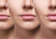 For How Long Do Lip Fillers Endure? What You Required to Know Lip Fillers