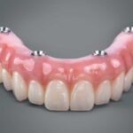 How Long Do All-on-4 Implants Last? All-on-4 Implants