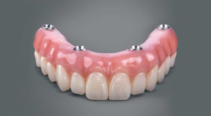 How Long Do All-on-4 Implants Last? All-on-4 Implants