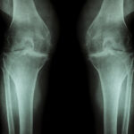 Knee and Hip Exercises for Osteoarthritis Arthrose Knie