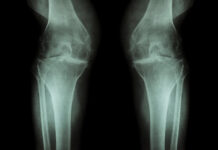 Knee and Hip Exercises for Osteoarthritis Arthrose Knie