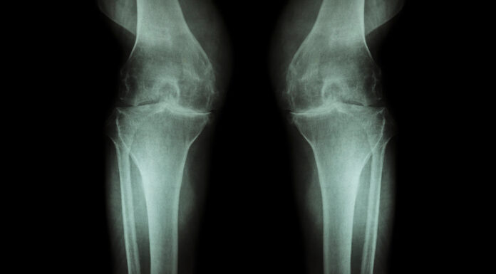 Knee and Hip Exercises for Osteoarthritis Arthrose Knie