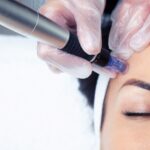 What are Derma Pen and Its Advantages?